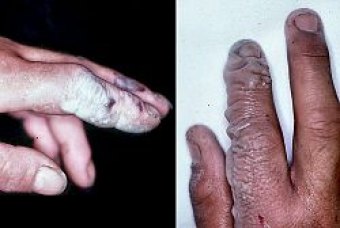 Deadly Hydrogen Fluoride Sent to Waste Treatment Plant EPA Records Show HF burn